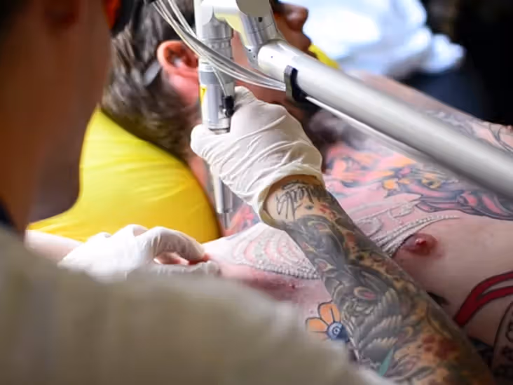 Tattoo Laser Removal